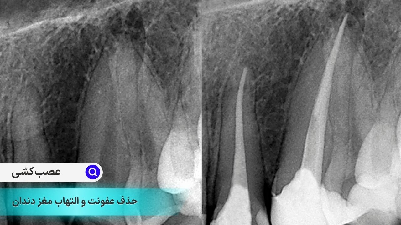 عصب کشی یا اندودنتیک