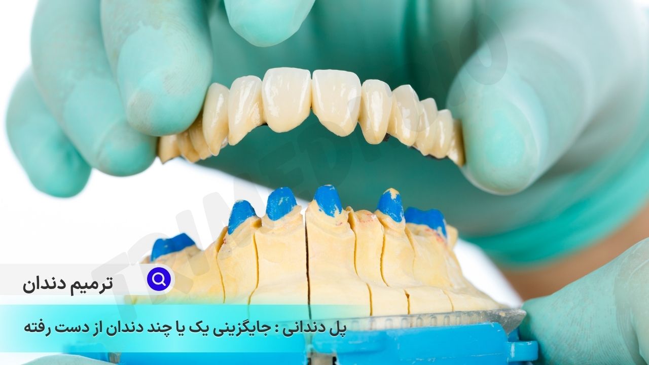 روش‌های ترمیم دندان، پل دندانی