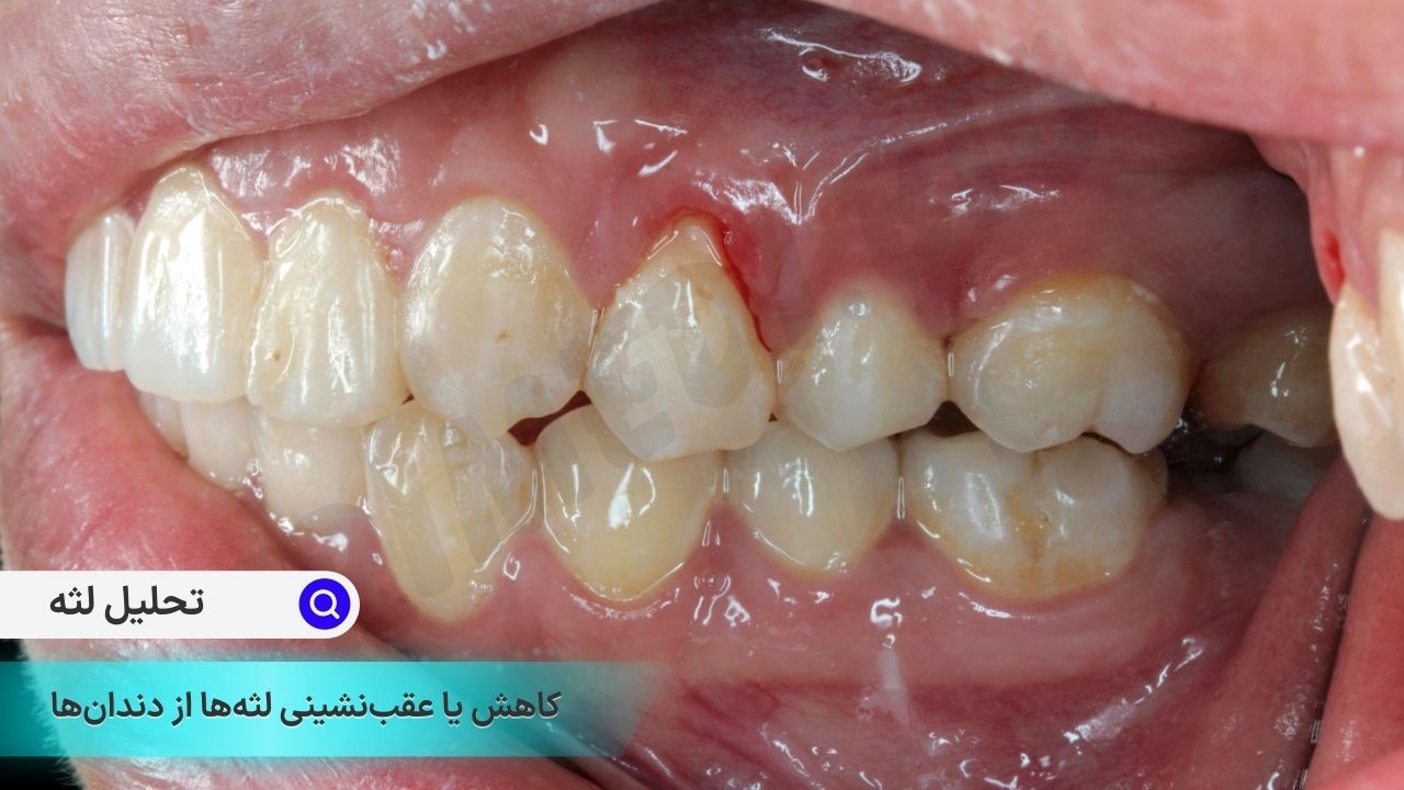 تحلیل لثه (Gum Recession) به وضعیت کاهش یا عقب‌نشینی لثه‌ها از دندان‌ها گفته می‌شود.