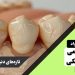 انواع مواد ترمیمی دندانپزشکی