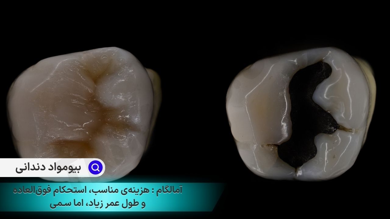 بیومواد ترمیمی دندانی، آمالگام