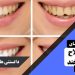 روش‌های اصلاح لبخند