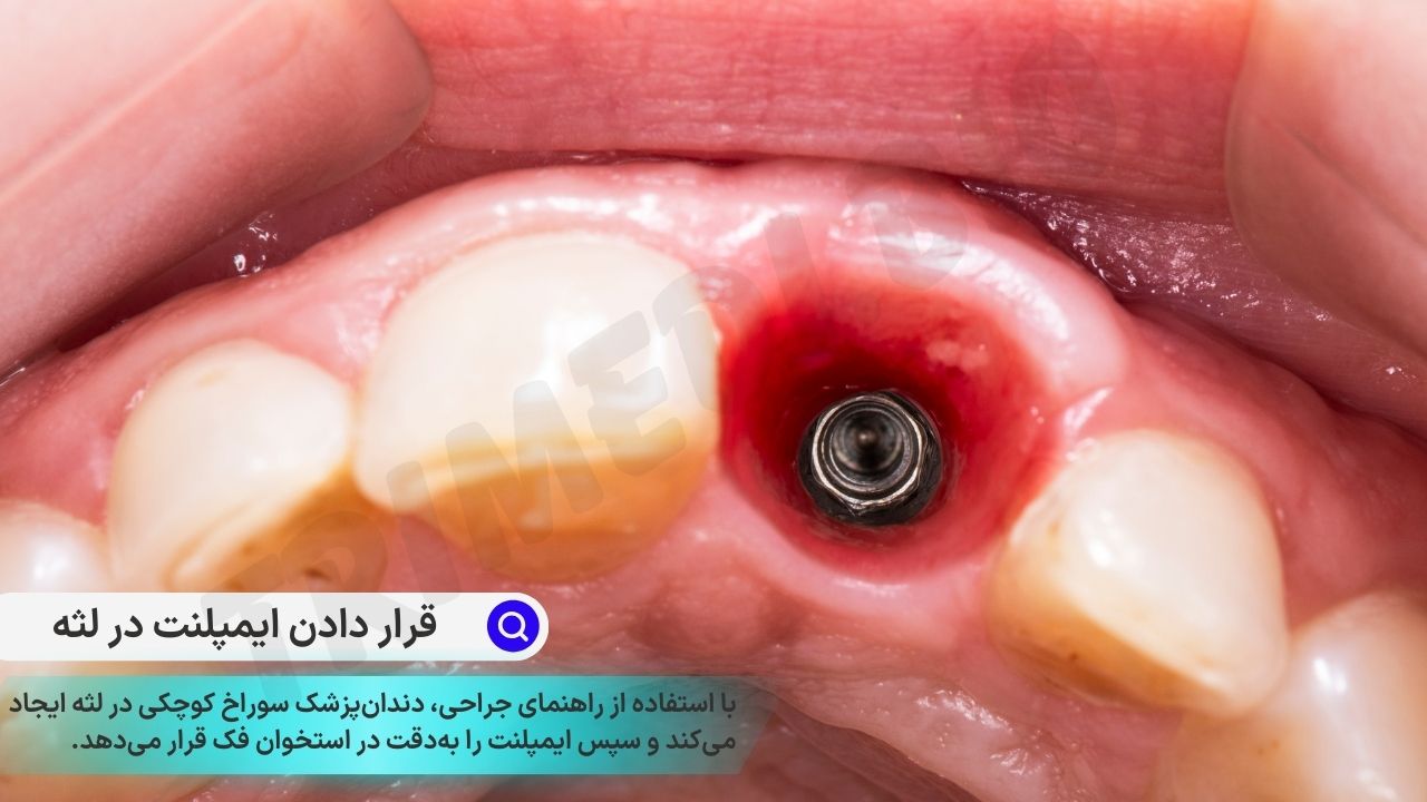 ایمپلنت دندان بدون جراحی