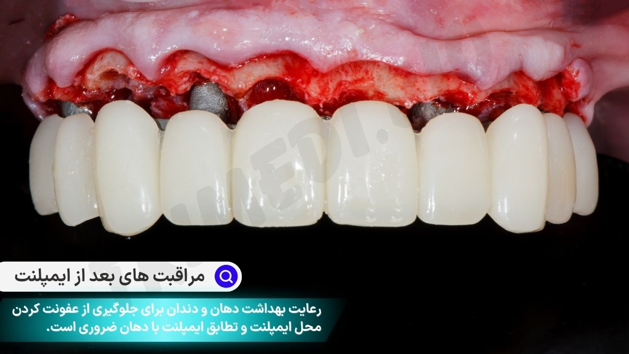 مراقبت های پس از ایمپلنت دندان