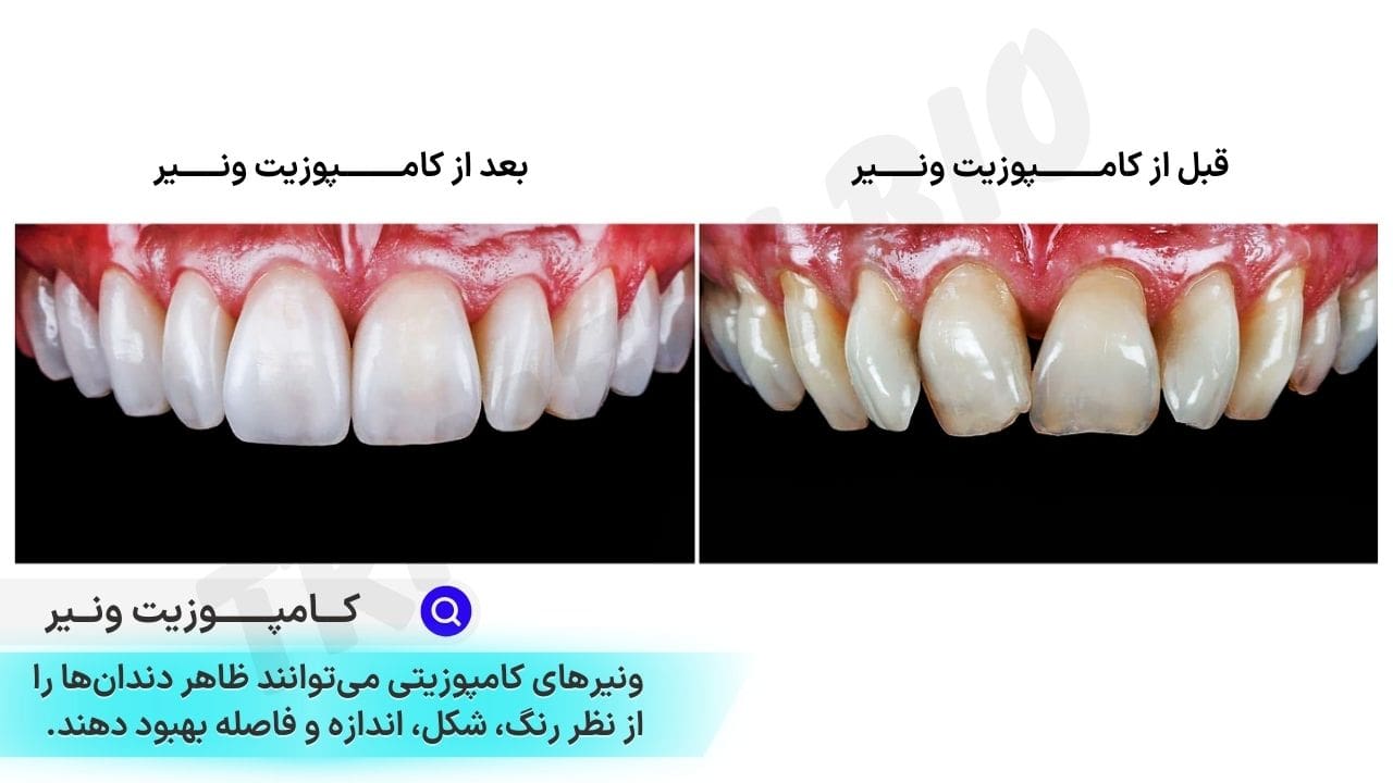 عکس قبل و بعد از ونیر کامپوزیت