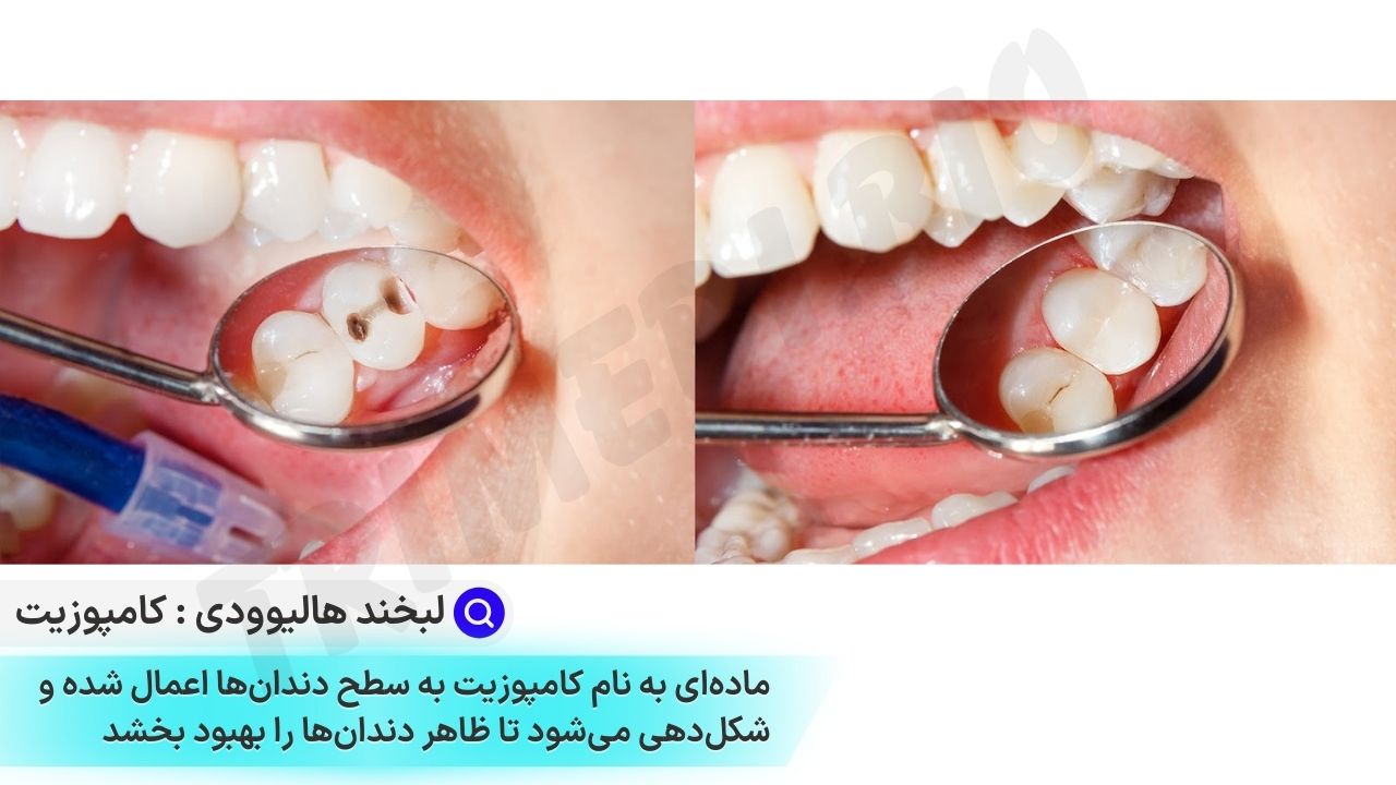 راز لبخند هالیوودی با کامپوزیت