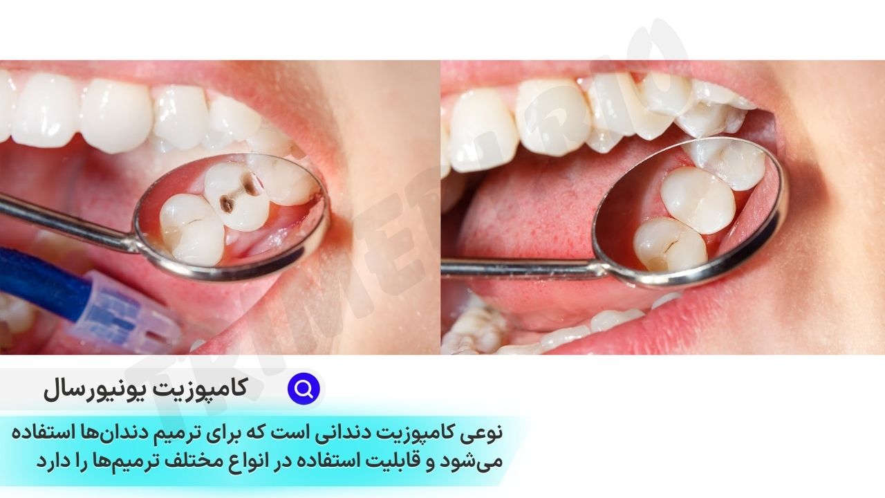 تفاوت کامپوزیت یونیورسال و زیبایی